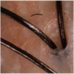 After our microbermabrasion treatment